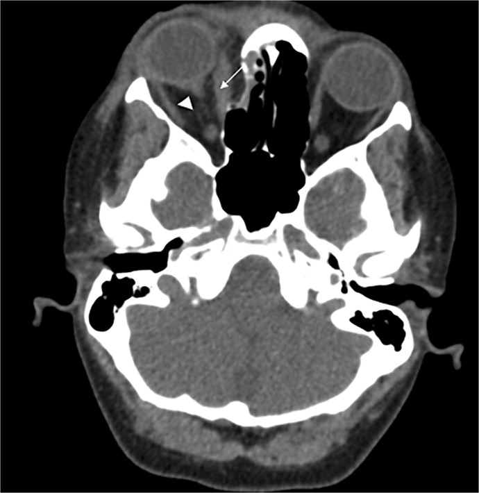 Double Jeopardy: Uncommon Concurrent Traumatic Optic Neuropathy and Central Retinal Artery Occlusion - A Case Report.