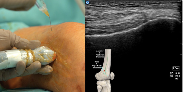 Genicular Nerve Ultrasound-Guided Cryoanalgesia for the Treatment of Chronic Knee Joint Pain: An Observational Retrospective Study.