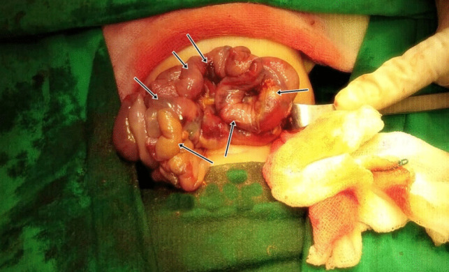 Selenium deficiency is functionally linked with the molecular etiopathogenesis of necrotizing enterocolitis (NEC).