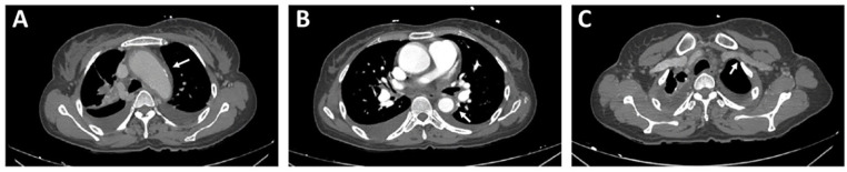 Takayasu's Arteritis with Systemic Lupus Erythematosus: A Case Report.
