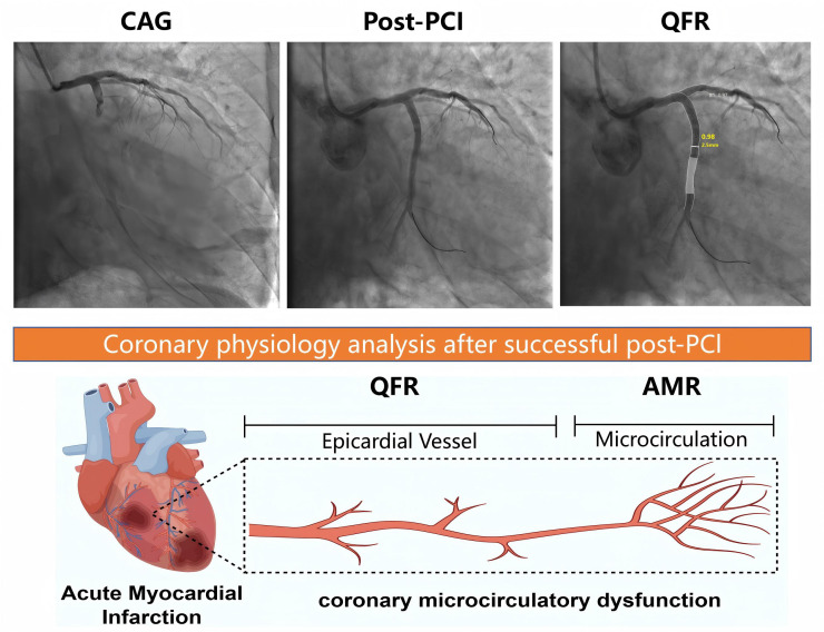 Construction and Clinical Relevance of a Predictive Model of Coronary Microcirculatory Dysfunction in Patients With Acute Myocardial Infarction Following Percutaneous Coronary Intervention.