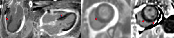 Monoclonal gammopathy progressing to systemic amyloidosis with cardiac involvement. A case report.