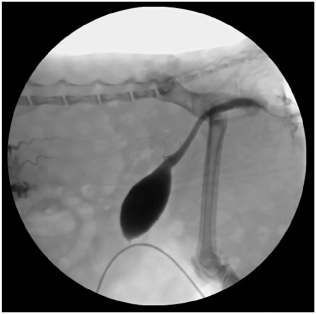 Renal parenchymal rupture, pelvic rupture and uroabdomen secondary to bilateral renal hemorrhage and pyelonephritis in a cat.