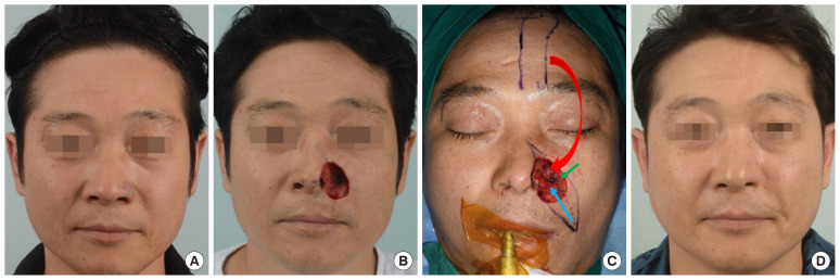 Reconstruction of large facial defects using three or more local flaps.