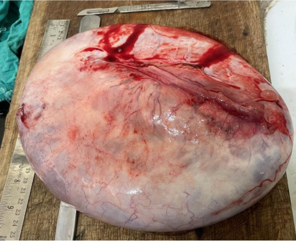 Giant Cystic Mucinous Borderline Tumour of the Ovary in a Young Female: A Rare Case Report.
