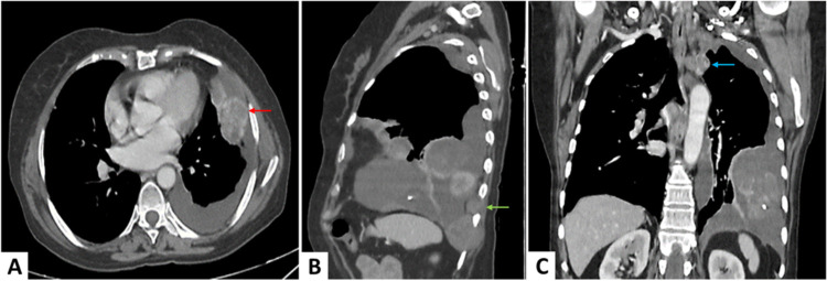 Low-grade fibromyxoid sarcoma, a rare tumor at an unusual site: Case report and review of literature.