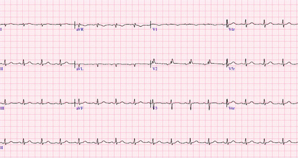 Monoclonal gammopathy progressing to systemic amyloidosis with cardiac involvement. A case report.