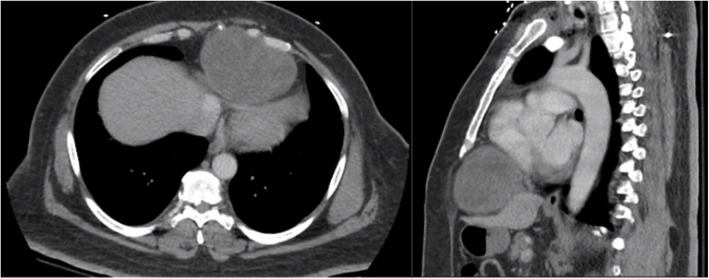 Rare case of a massive anterior mediastinal schwannoma causing cardiac compression with concurrent cervical spine lesion causing spinal cord compression.