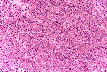 Clear Cell Carcinoma: A Rare Variant of Cholangiocarcinoma Case Report and Systematic Review.