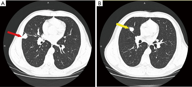 Surgical treatment of IIIb (N2), ROS1(+) non-small cell lung cancer after neoadjuvant chemotherapy combined with targeted therapy: a case report.