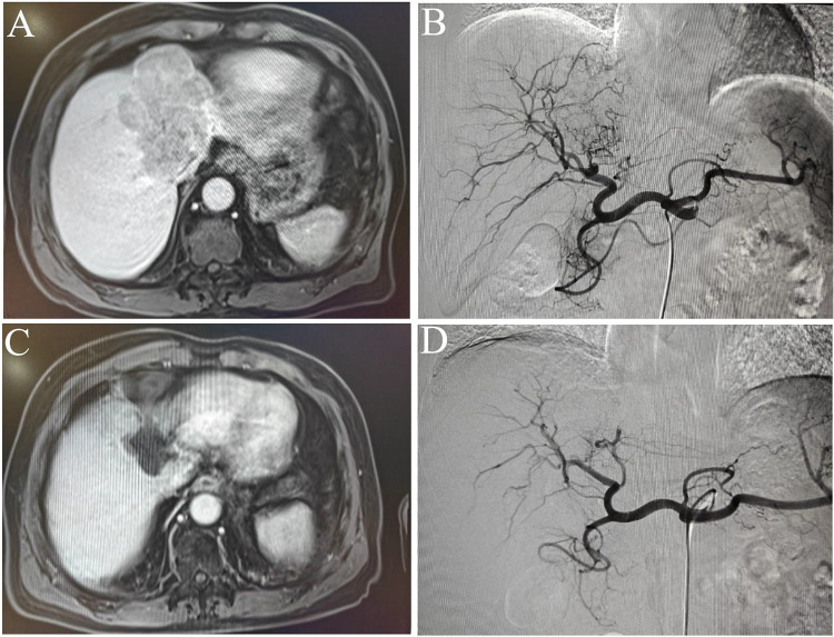 Hepatic Arterial Infusion Chemotherapy Combined Apatinib/Camrelizumab for Recurrent Hepatocellular Carcinoma After Hepatectomy.