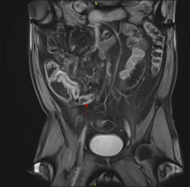 New Diagnosis of Granulomatosis With Polyangiitis Presenting With Oral Ulcerations, Ileitis, and Hematochezia.