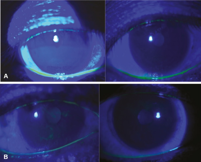 Comparison of 20% Autologous Platelet-Rich Plasma Versus Conventional Treatment in Moderate to Severe Dry Eye Patients.