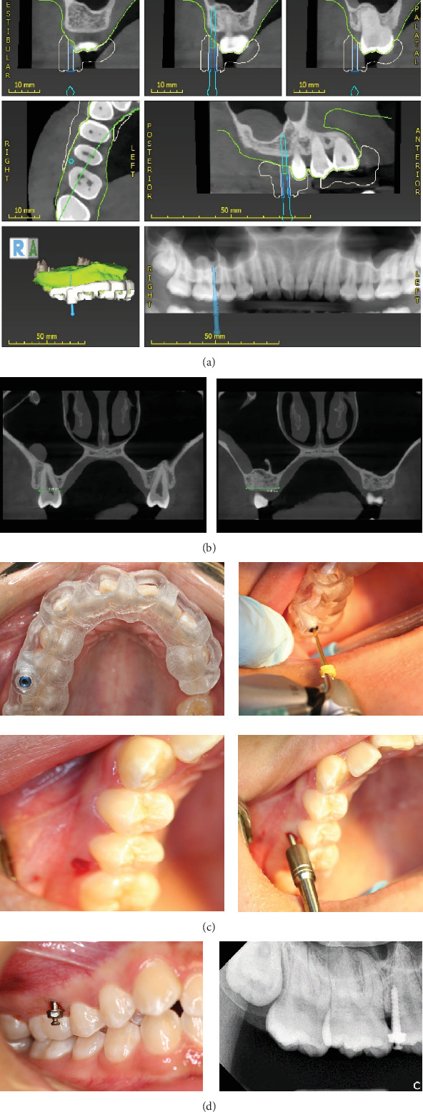 The Use of the Surgical Guide for Placing Miniscrew in Treatment of Class II Subdivision: A Case Report With 2-Year Follow-Up.