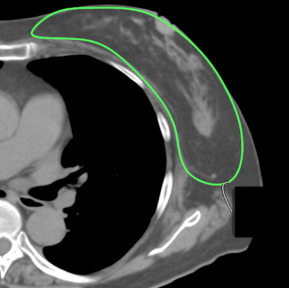 Use of Three-Dimensional Surface Imaging to Measure Breast Volume in the Upright Position With Acceptable Accuracy.