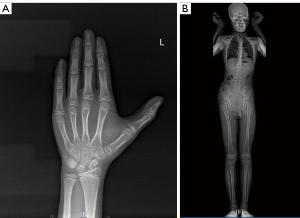 A novel <i>EFTUD2</i> splicing variant causing mandibulofacial dysostosis with microcephaly: a case report.