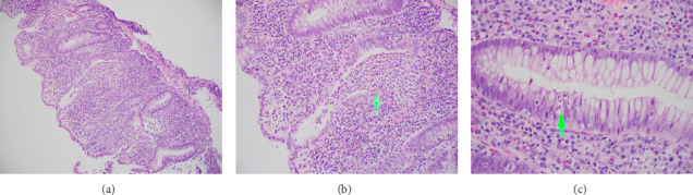 Development of Ulcerative Colitis in a Patient With Human Immunodeficiency Virus.