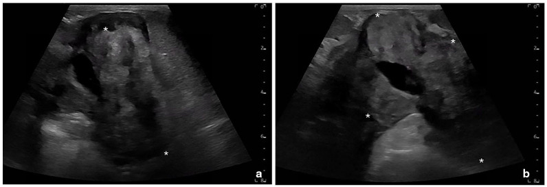 Bicavitary involvement of feline eosinophilic sclerosing fibroplasia with intralesional methicillin-resistant <i>Staphylococcus aureus</i>.