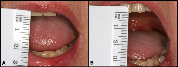 Importance of early arthrocentesis in temporomandibular joint closed lock by disc displacement without reduction. A case review.