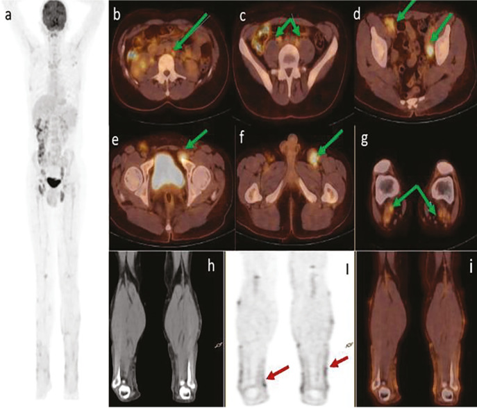 <sup>18</sup>F-FDG PET/CT of a Multicentric Castleman Disease with Lymph Node and Skin Involvement.