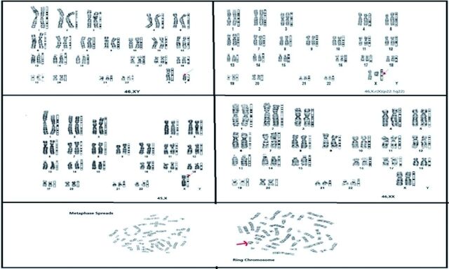 Identification of genetic variants in patients with primary and secondary amenorrhea.