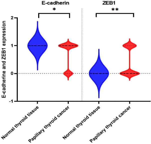 Role of epithelial-mesenchymal markers in predicting metastasis of papillary thyroid carcinoma: A retrospective case-control study.