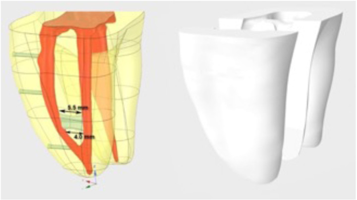 An in vitro evaluation of biofilm removal from simulated root canals using sodium hypochlorite irrigation solution at various temperature settings.