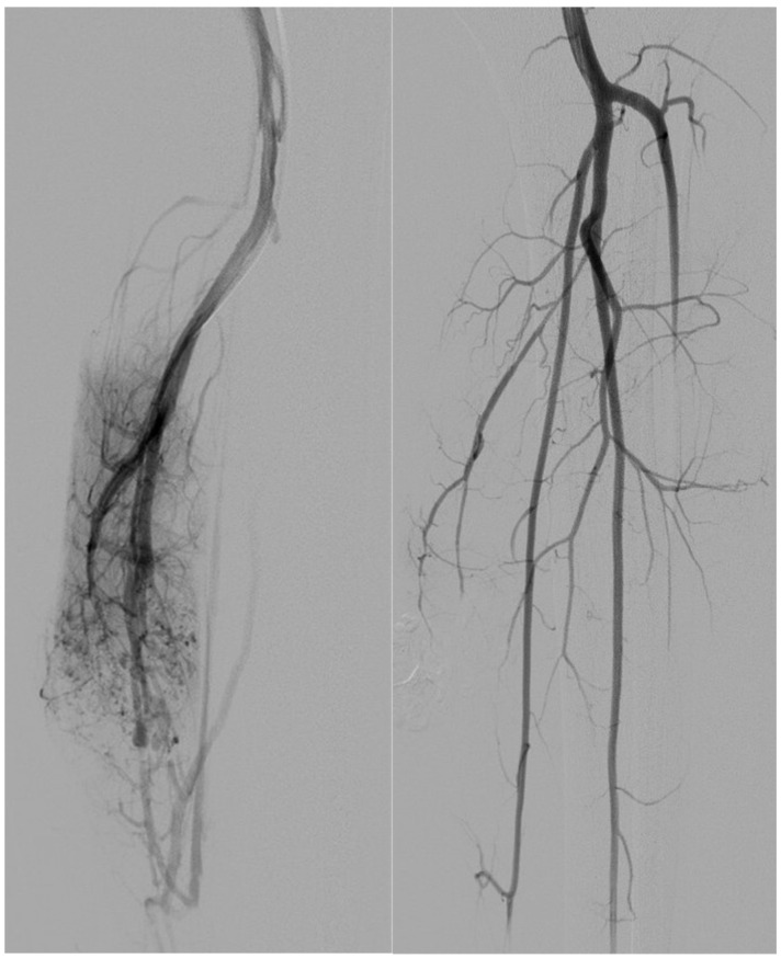 Endovascular Treatment of Extracranial Arteriovenous Malformations: A Retrospective Monocentric Case-Series Study.