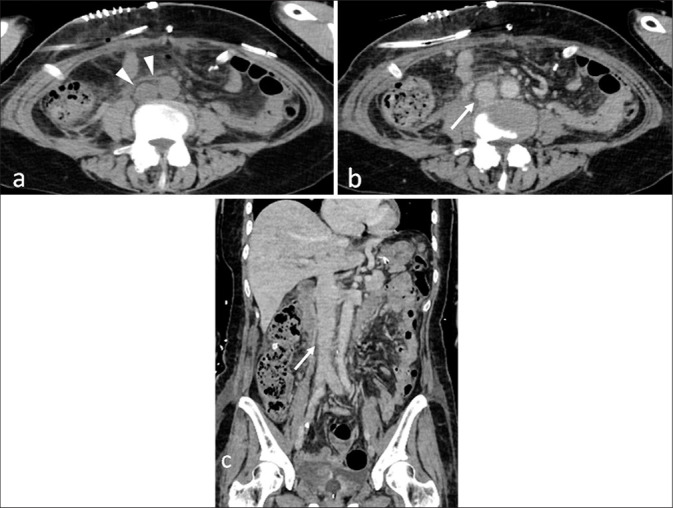 Blunt traumatic inferior vena cava injury associated with seatbelt syndrome: The critical role of diagnosis and non-operative management.