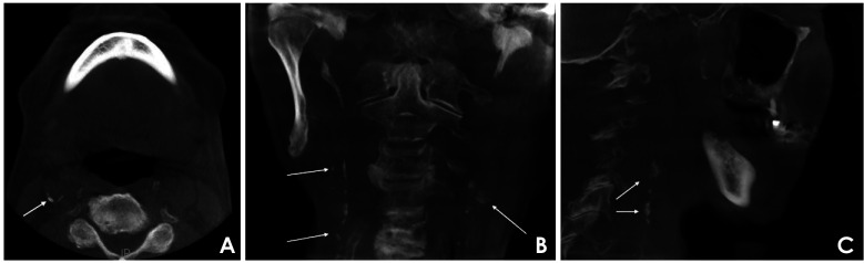 Vascular-related cone-beam computed tomographic findings in healthy and medically compromised patients: A study based on self-reported medical history data.