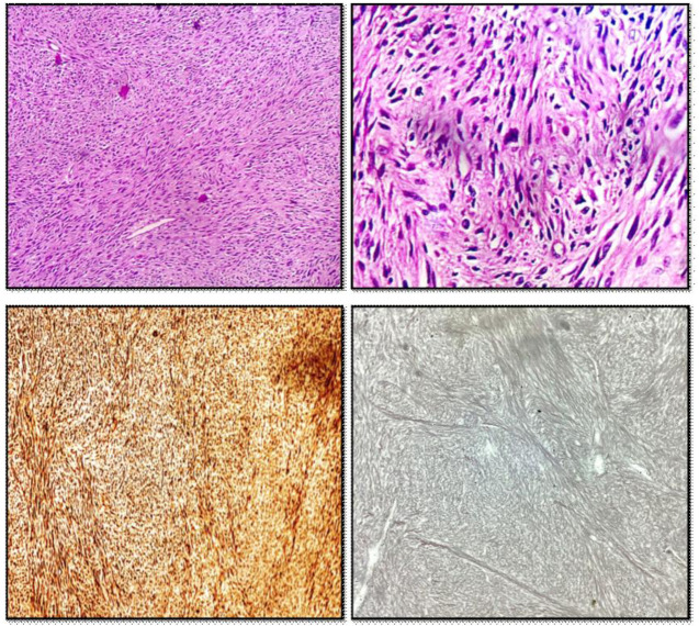 Unusual Retroperitoneal Soft Tissue Sarcomas: Giant Masqueraders.