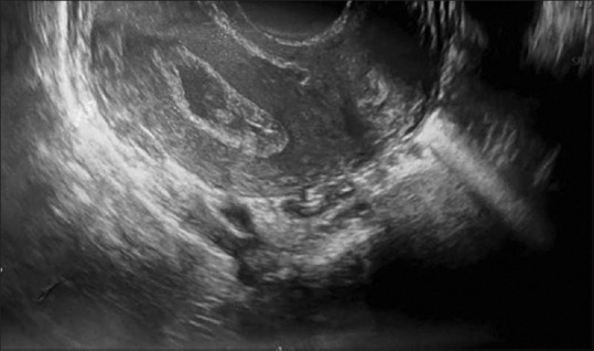 Surgical Management of Cervical Canal Stenosis with Clinical Tuberculosis Using Foley's Catheter Stent: A Case Report.