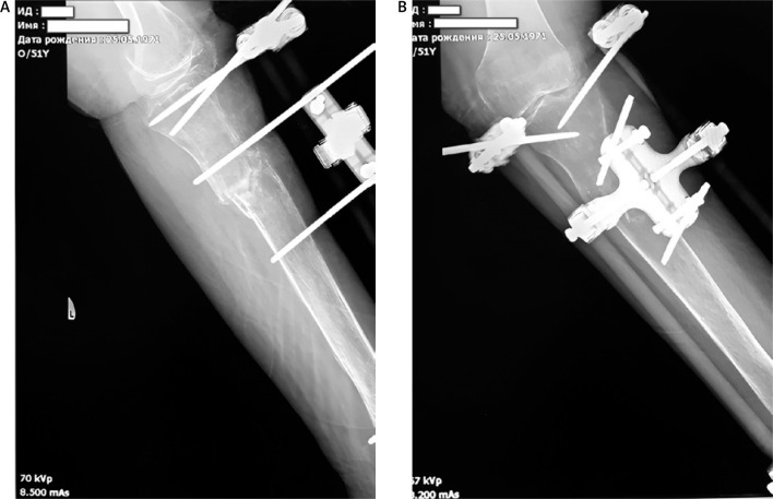 The use of regenerative technologies for treatment of delayed fracture union in patient with menopausal osteoporosis.