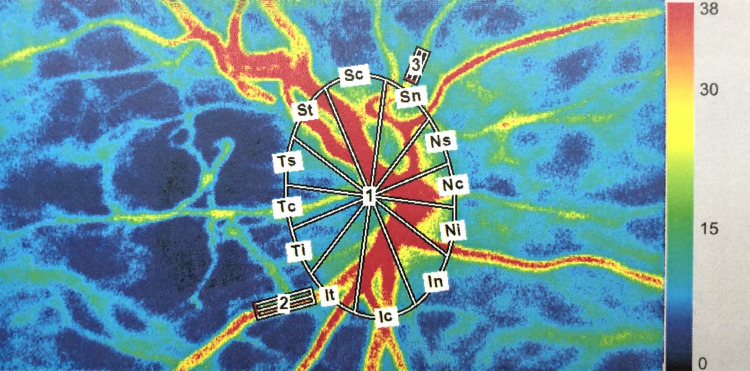 Alterations on Microcirculation of Optic Nerve Head Before and After OSA Surgery.