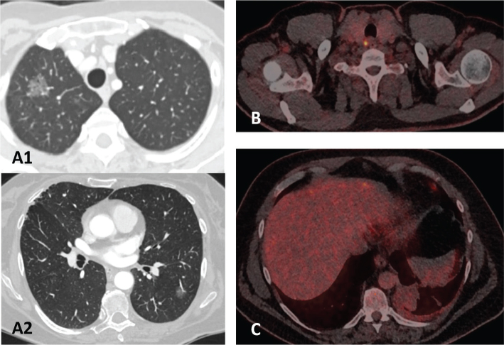 Discrepancies in regional lung cancer multidisciplinary team decisions can be reduced through national consensus meetings.