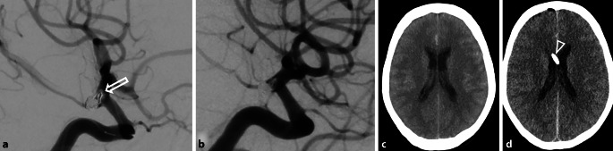 Role and Safety of Tirofiban in Peri-Interventional Antiplatelet Management for Aneurysm Treatment.
