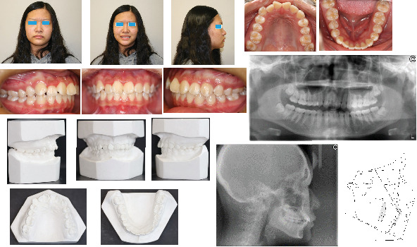 The Use of the Surgical Guide for Placing Miniscrew in Treatment of Class II Subdivision: A Case Report With 2-Year Follow-Up.