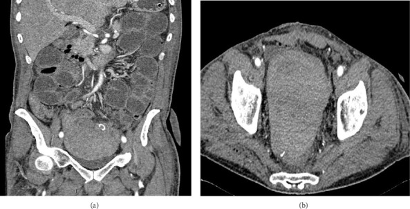 Life-Threatening Bleeding From Acquired FXI Inhibitors in a Patient With Colorectal Adenocarcinoma.