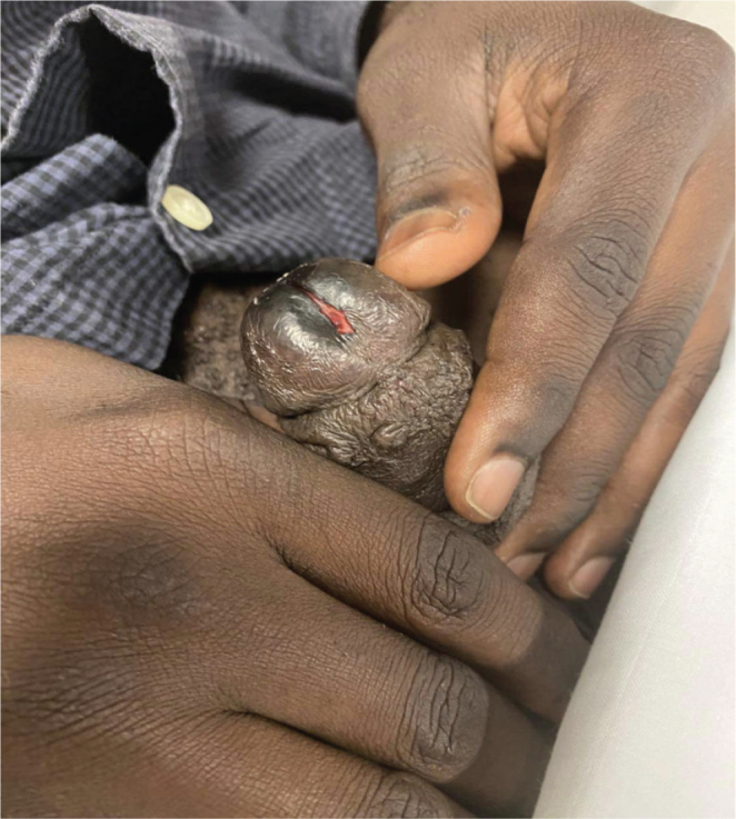 Penile Ulceration After Local Injection of Metaphedrone During Chemsex.