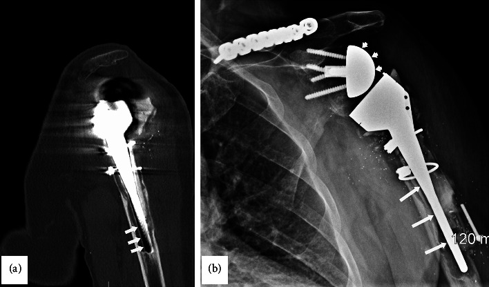 Radial Nerve Palsy as an Iatrogenic Complication of Shoulder Replacement Surgery With Significant Bone Loss of the Humerus Resembling Gorham-Stout Disease: Case Report and Review of the Literature.