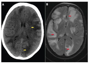 Intracranial Tuberculomas Associated with Tuberculous Meningitis.