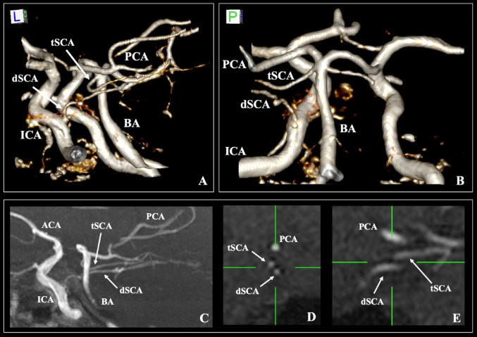 Persistent trigeminal artery variant functioning as a duplicate superior cerebellar artery.