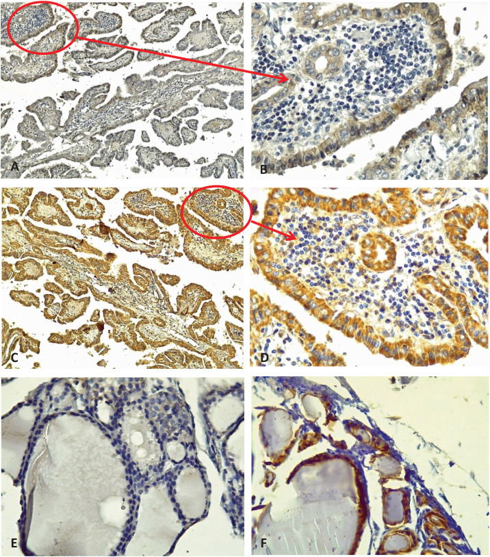 Role of epithelial-mesenchymal markers in predicting metastasis of papillary thyroid carcinoma: A retrospective case-control study.