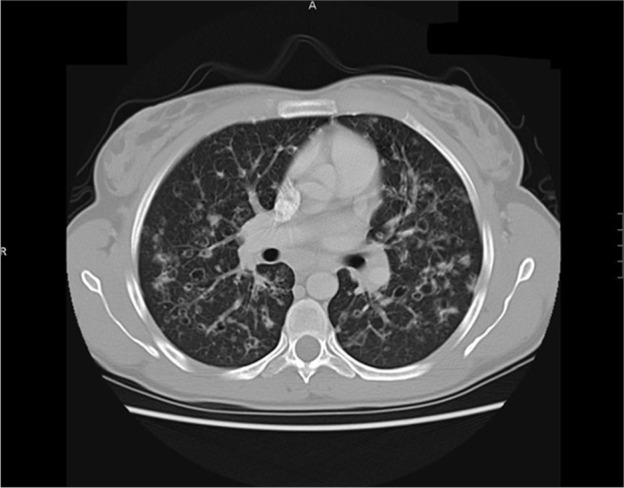 Pulmonary Langerhans cell histiocytosis: A case series and literature review.