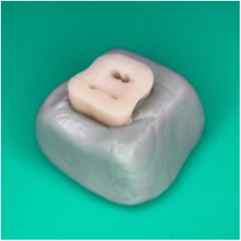 An in vitro evaluation of biofilm removal from simulated root canals using sodium hypochlorite irrigation solution at various temperature settings.