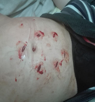 Fetal demise due to stab wound with umbilical cord transection: a case report.
