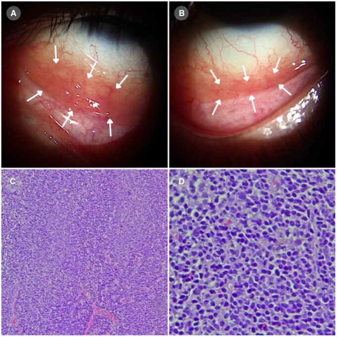 MALT conjunctival lymphoma in Sjögren's disease.
