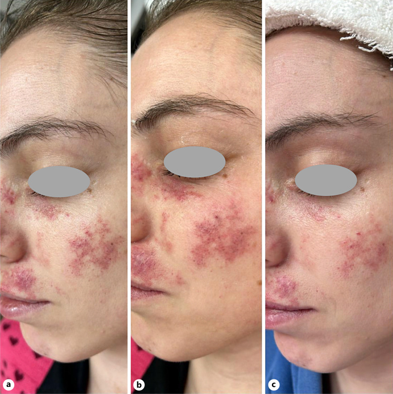 Efficacy of Sequential Combination of Long-Pulsed Potassium Titanyl Phosphate 532-nm and Quasi Long-Pulsed 1,064-nm Nd:YAG Laser Therapy for Port-Wine Stain Treatment: A Case Report.