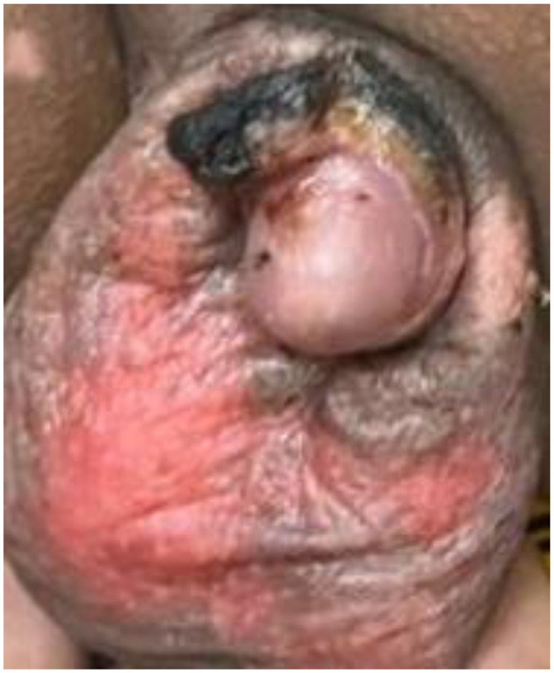 A rare scrotal burn from post-circumcision cetrimide-chlorhexidine (savlon) dressing: Case report and literature review.
