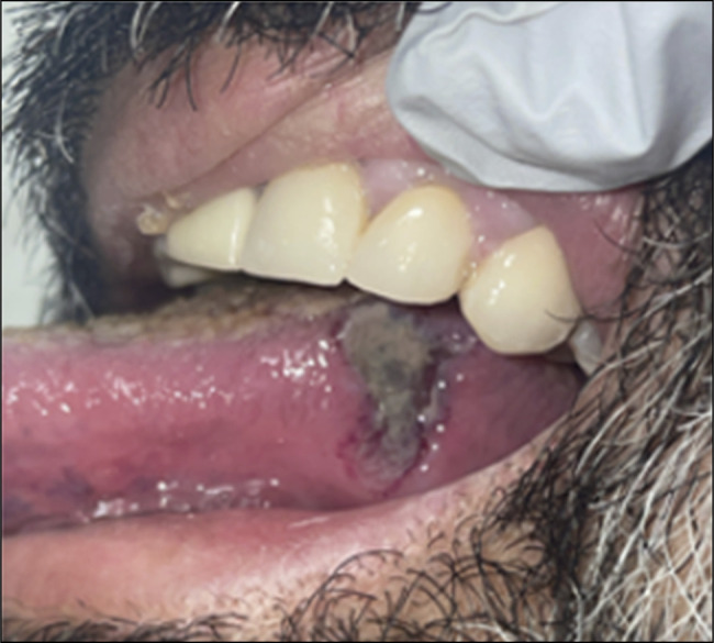 New Diagnosis of Granulomatosis With Polyangiitis Presenting With Oral Ulcerations, Ileitis, and Hematochezia.
